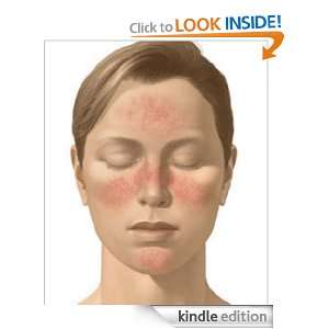 Dealing With Rosacea Effective Skin Care Strategies For Prevention 
