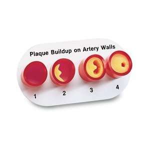  Artery Sections with Blockage 